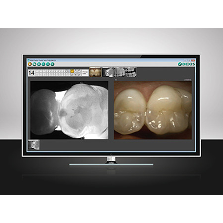 DEXIS CariVu™ Caries Detection Device  - Distributed by Henry Schein