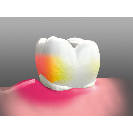 ACTEON SOPROCARE Caries Detection Device - Distributed by Henry Schein