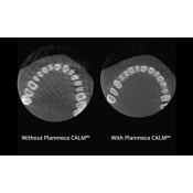 Left image is a standard scan without Planmeca CALM™, the right image is the improved image with Planmeca CALM™